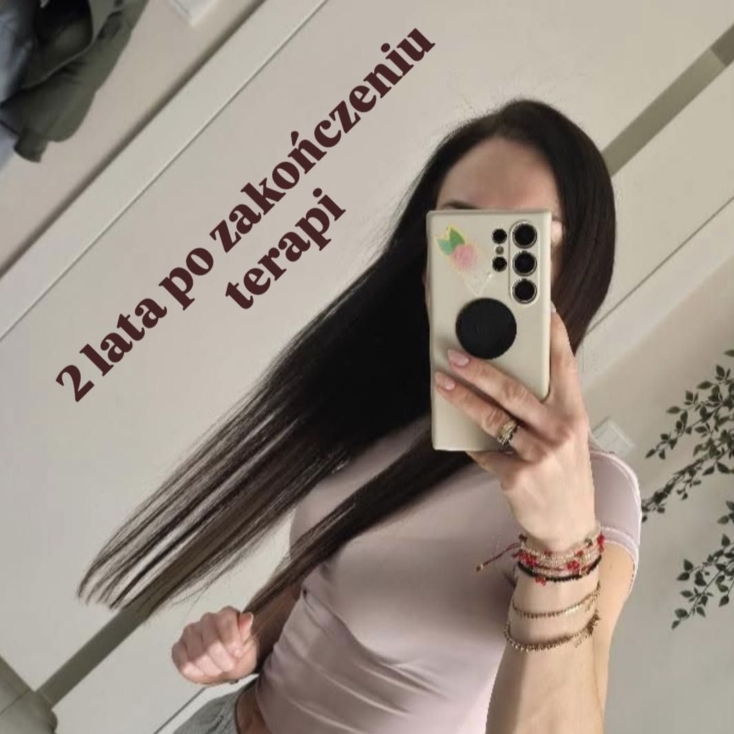 Efekt dwa lata po zakończeniu terapii trychologicznej w Botricho